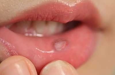 10 bài thuốc dân gian trị viêm loét miệng