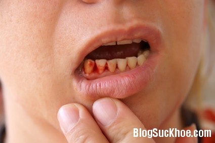 Cách chữa chảy máu chân răng