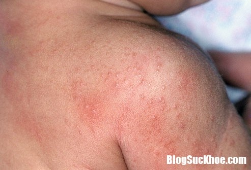 Những bệnh ngoài da thường gặp trong mùa hè và cách phòng ngừa