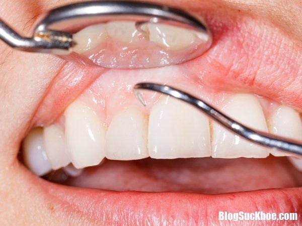 Những nguy hại sức khỏe do bệnh nướu răng gây ra