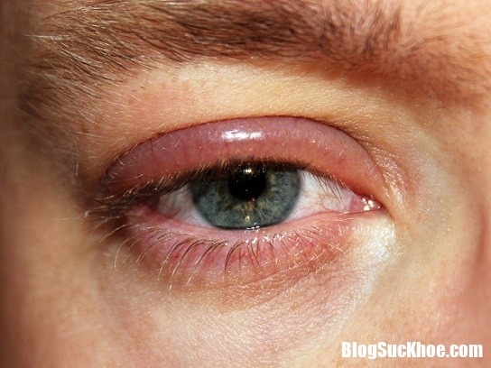 Những bệnh về mắt thường gặp nhất