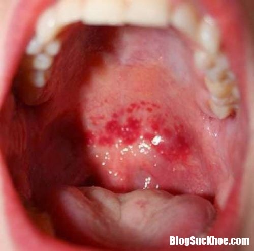 Những dấu hiệu cảnh báo ung thư vòm họng giai đoạn đầu nên điều trị ngay