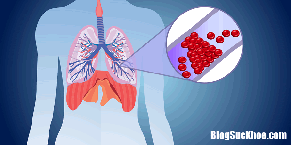 Nhồi máu phổi Một biến chứng nguy hiểm của bệnh tim mạch